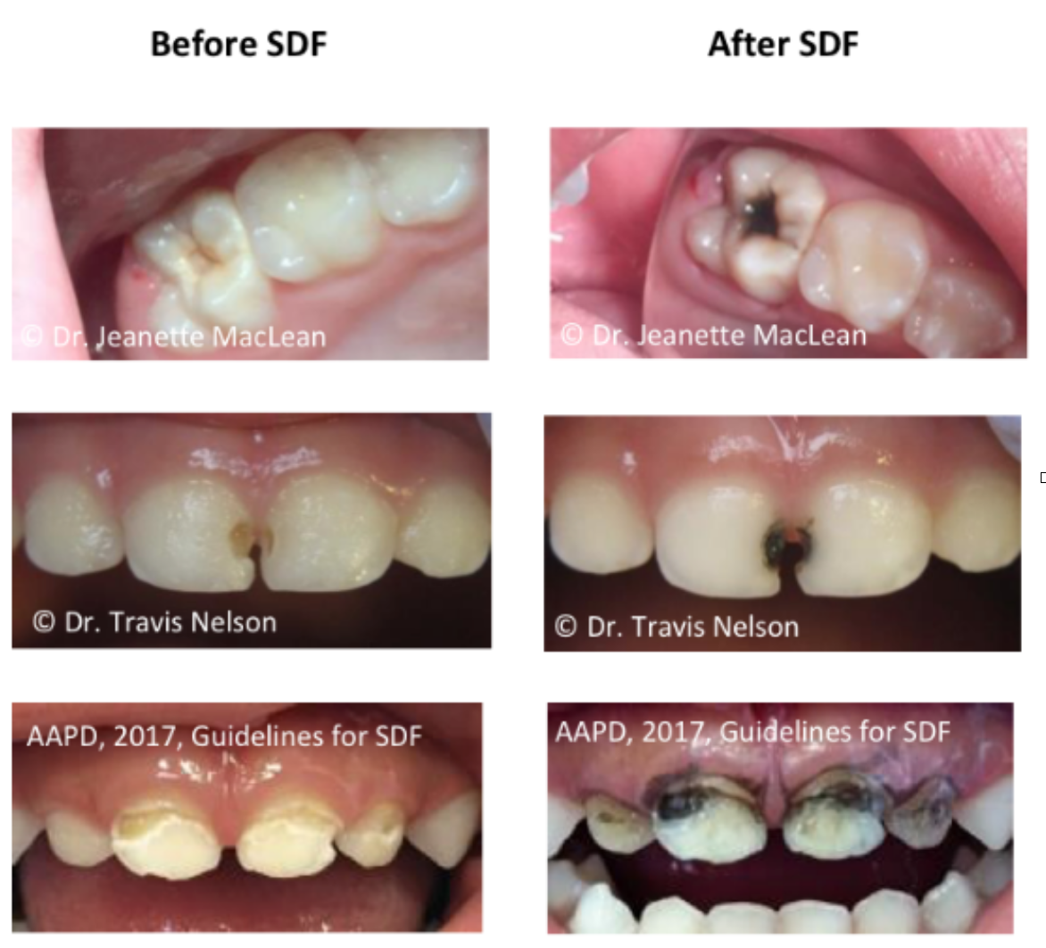 Before and after silver diamine fluoride treatment.